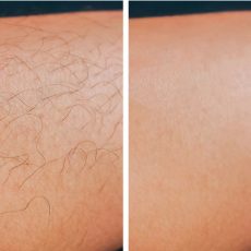 Hair removal 01